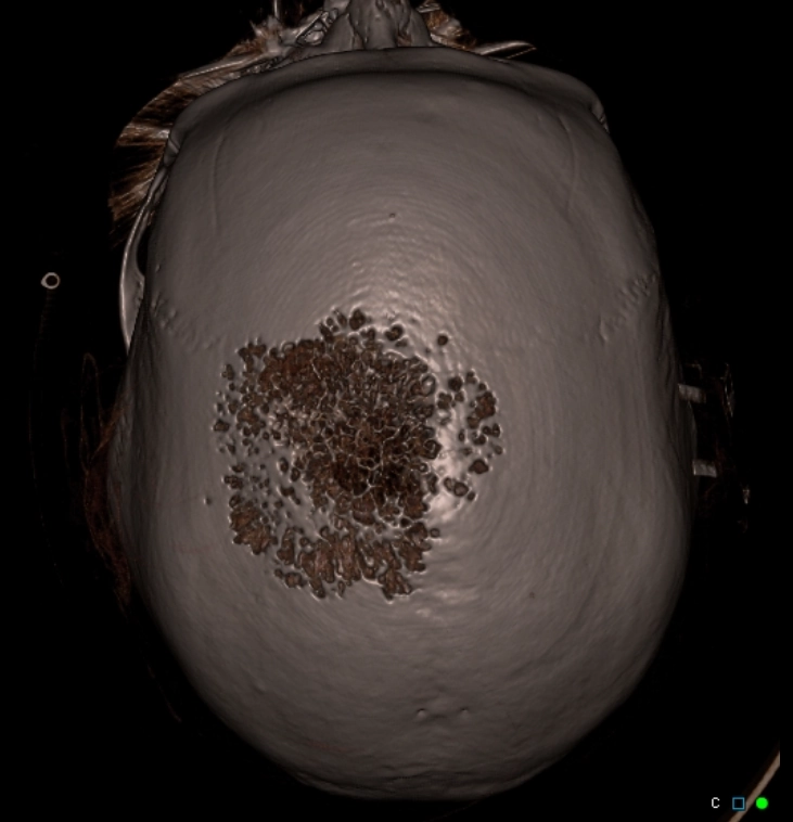U mạch máu vòm sọ (Skull Vault Hemangiomas - SVH)