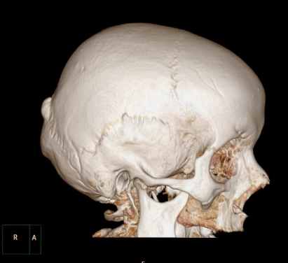 U xương dạng xương (Osteoma)