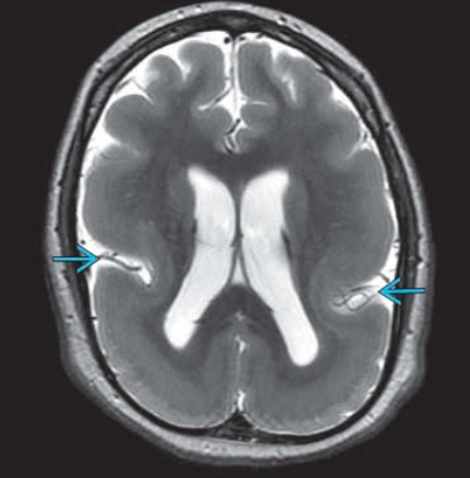 Nhẵn não (Lissencephaly)- CT,MRI