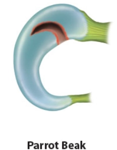 Rách sụn chêm kiểu mỏ vẹt (Parrot beak meniscal tear)