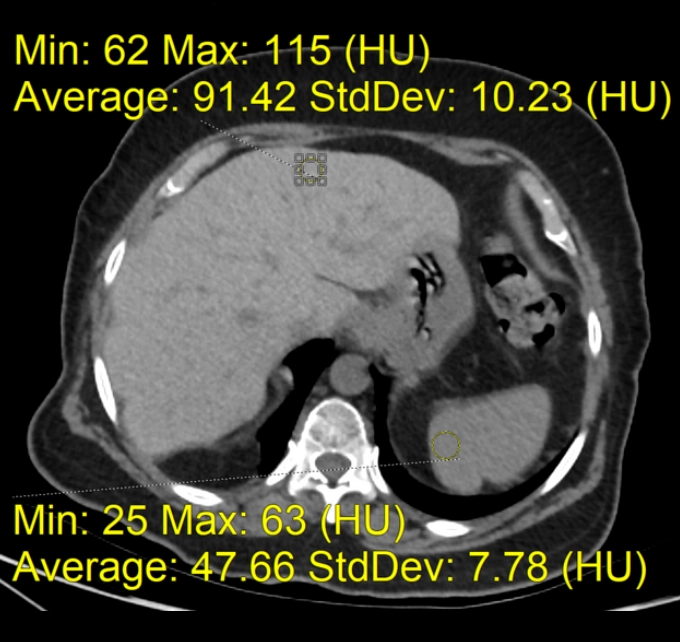 Lắng đọng amiodarone trong gan (Amiodarone deposition in the liver)