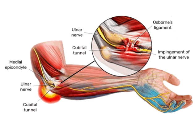 Tổn thương thần kinh trụ ở khuỷu (Ulnar Nerve Injury, Elbow)
