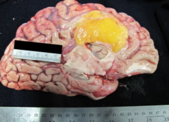 U mỡ nội sọ (Intracranial Lipoma)