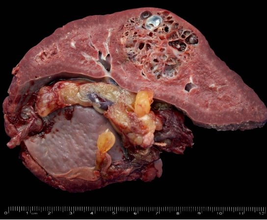 U máu lách (Splenic hemangioma)