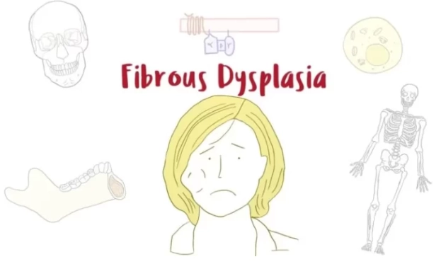Loạn sản xơ xương (Fibrous dysplasia - FD)
