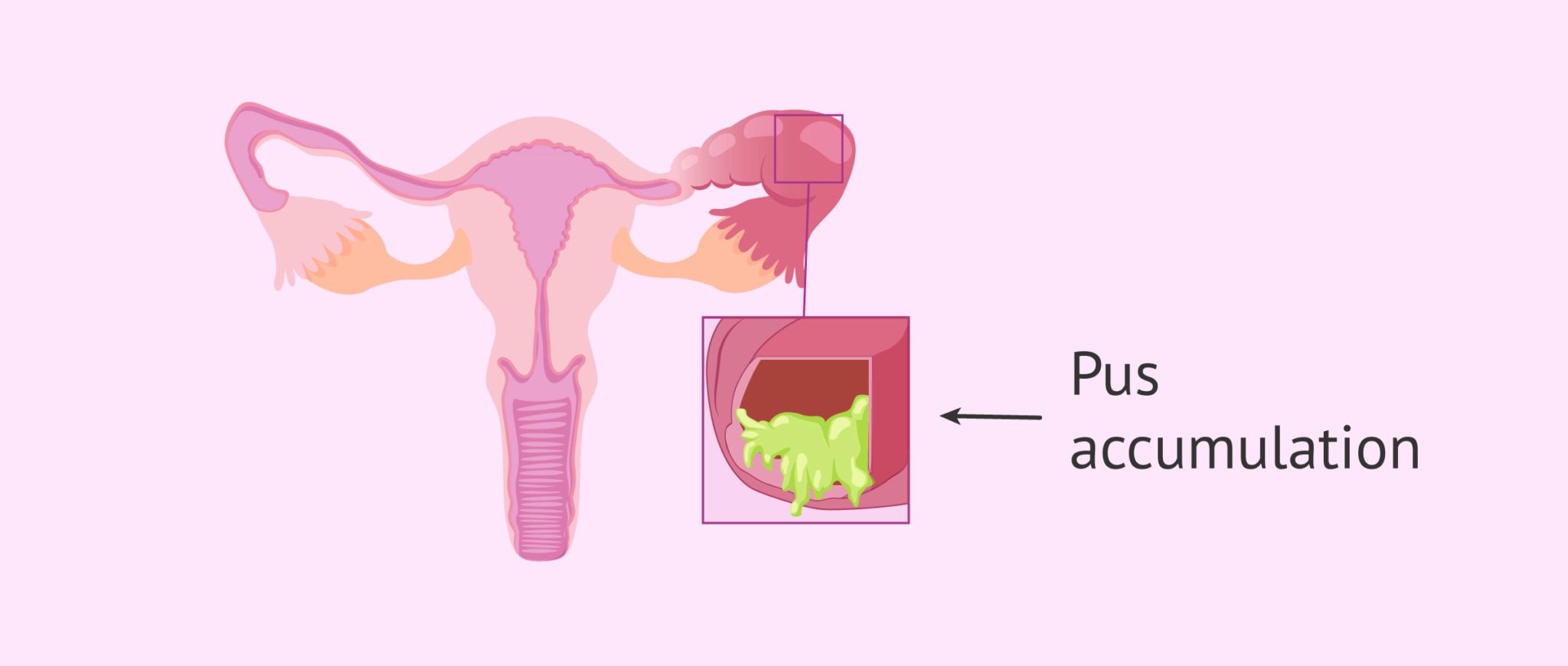 Ứ mủ vòi trứng (Pyosalpinx)