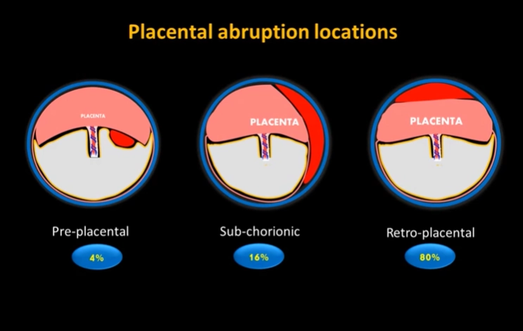 Nhau bong non (Placental Abruption)