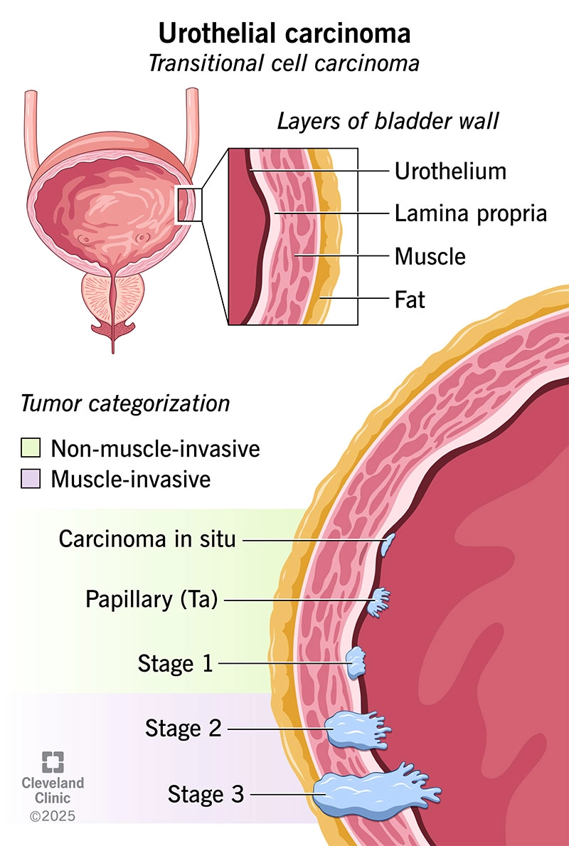Phân loại giai đoạn ung thư bể thận (Urothelial carcinoma of the renal pelvis (staging))