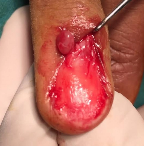 U cuộn mạch (Glomus tumor)