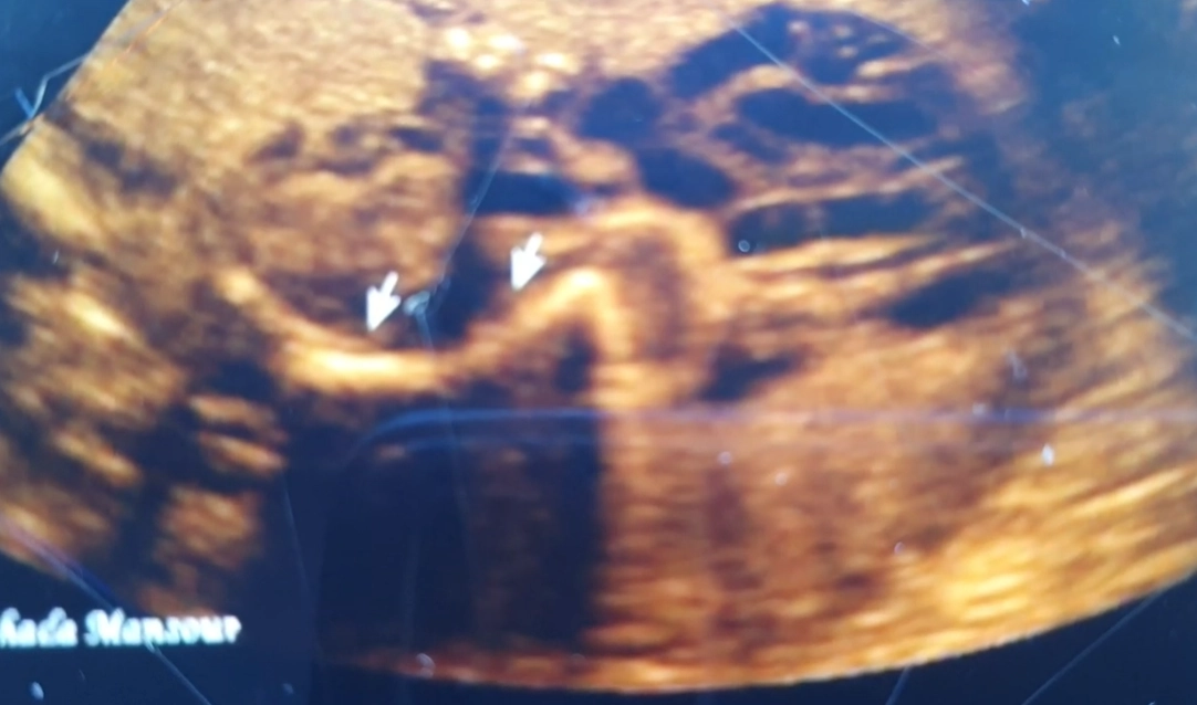 Xương cong ở thai nhi (Curved / Angulated Bones)