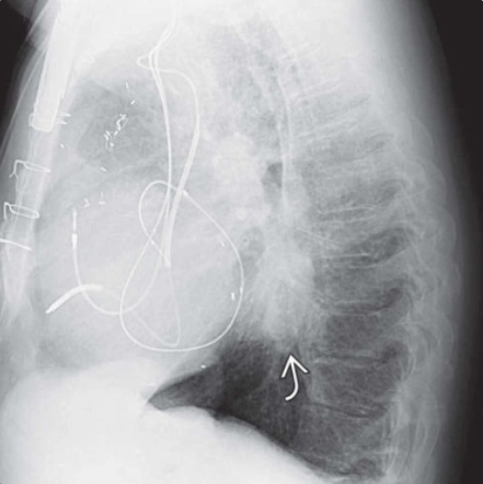 Giãn tĩnh mạch phổi (Pulmonary venous varix - PVV)