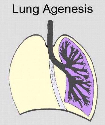Bất sản và thiểu sản phổi thai quý I (Pulmonary agenesis / Hypoplasia)