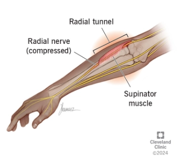 Tổn thương thần kinh quay ở khuỷu (Radial Nerve Injury, Elbow)