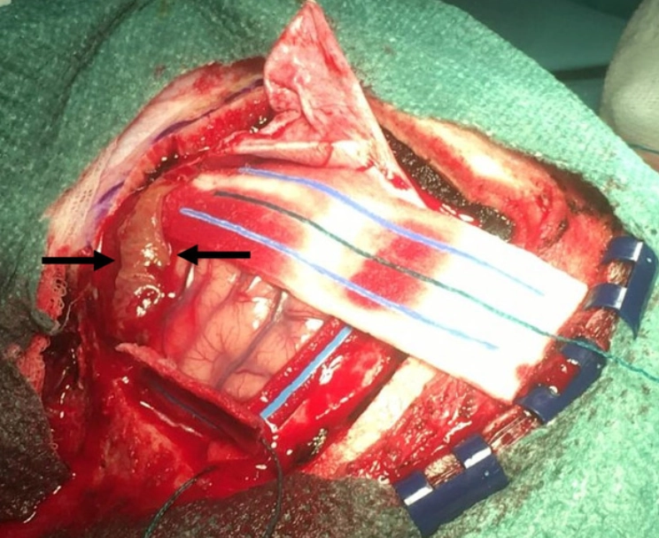 U tế bào thần kinh ngoài não thất (Extraventricular neurocytoma - EVN)