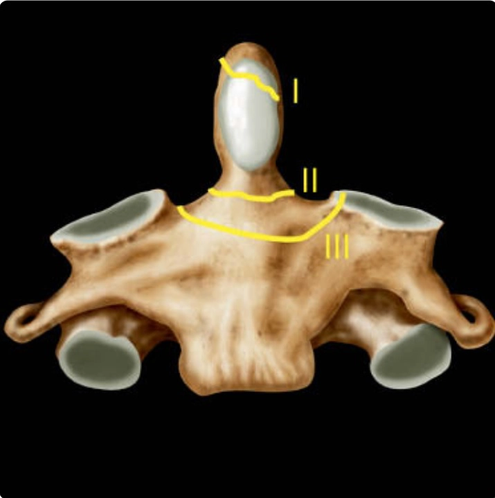 Chấn thương cột sống (Spine trauma)