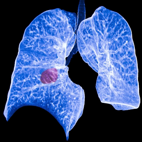 Ung thư phổi đa ổ nguyên phát khác thời điểm (Metachronous primary lung carcinoma)