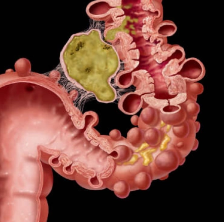 Viêm túi thừa đại tràng (Diverticulitis)