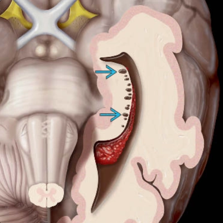Nang di tích rãnh hồi hải mã (Hippocampal remnant cyst)