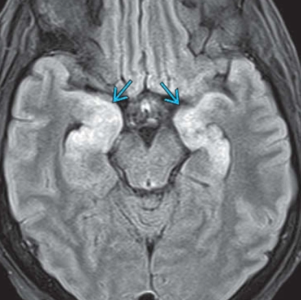 Viêm não tự miễn (Autoimmune Encephalitis) 
