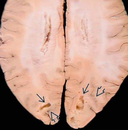 PRES- Hội chứng bệnh não sau có hồi phục (Posterior Reversible Encephalopathy Syndrome )