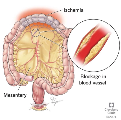 Thiếu máu ruột non (Small bowel ischemia)