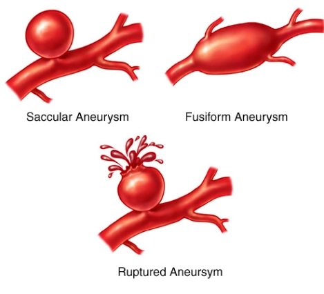 Xuất huyết dưới nhện do vỡ phình mạch (Aneurysmal Subarachnoid Hemorrhage - aSAH)