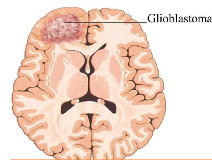 U não thai nhi (Fetal brain tumor)