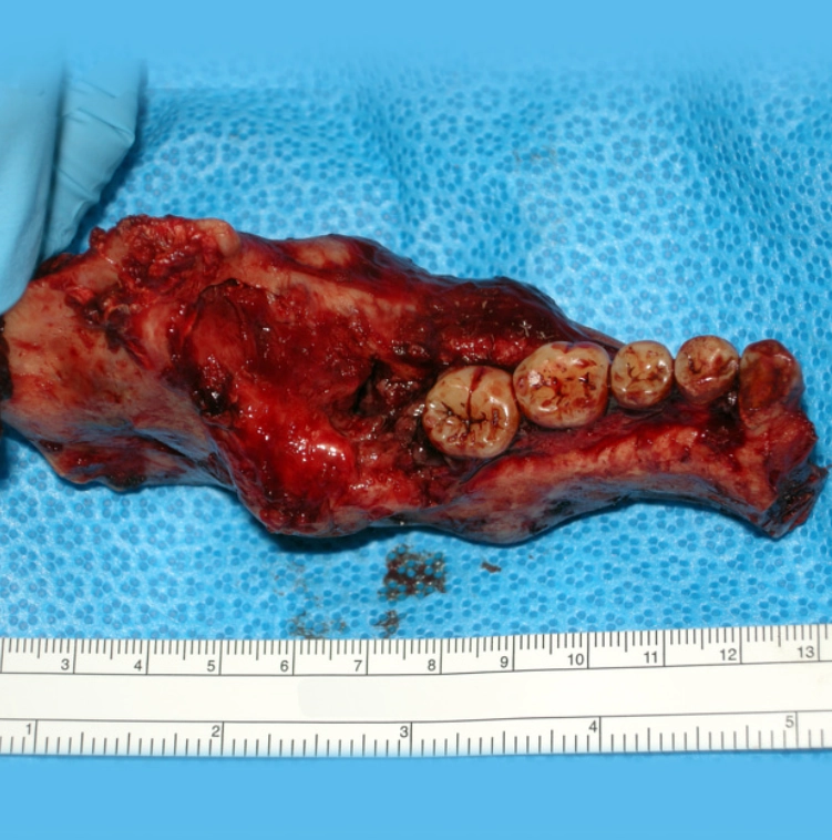 U men răng (Ameloblastoma)