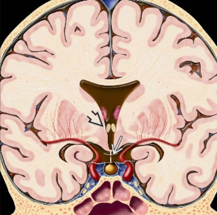 LOẠN SẢN VÁCH-THỊ (SEPTO-OPTIC DYSPLASIA - SOD) / HỘI CHỨNG DE MORSIER