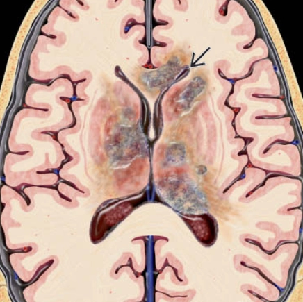 U lympho hệ thần kinh trung ương (Central Nervous System Lymphoma - CNS Lymphoma) 