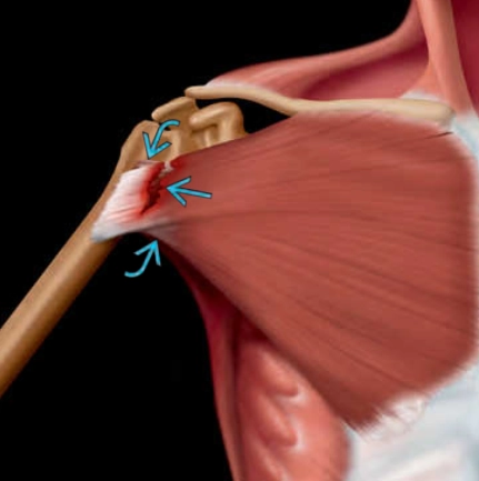 Tổn thương cơ ngực lớn (Pectoralis major injury)