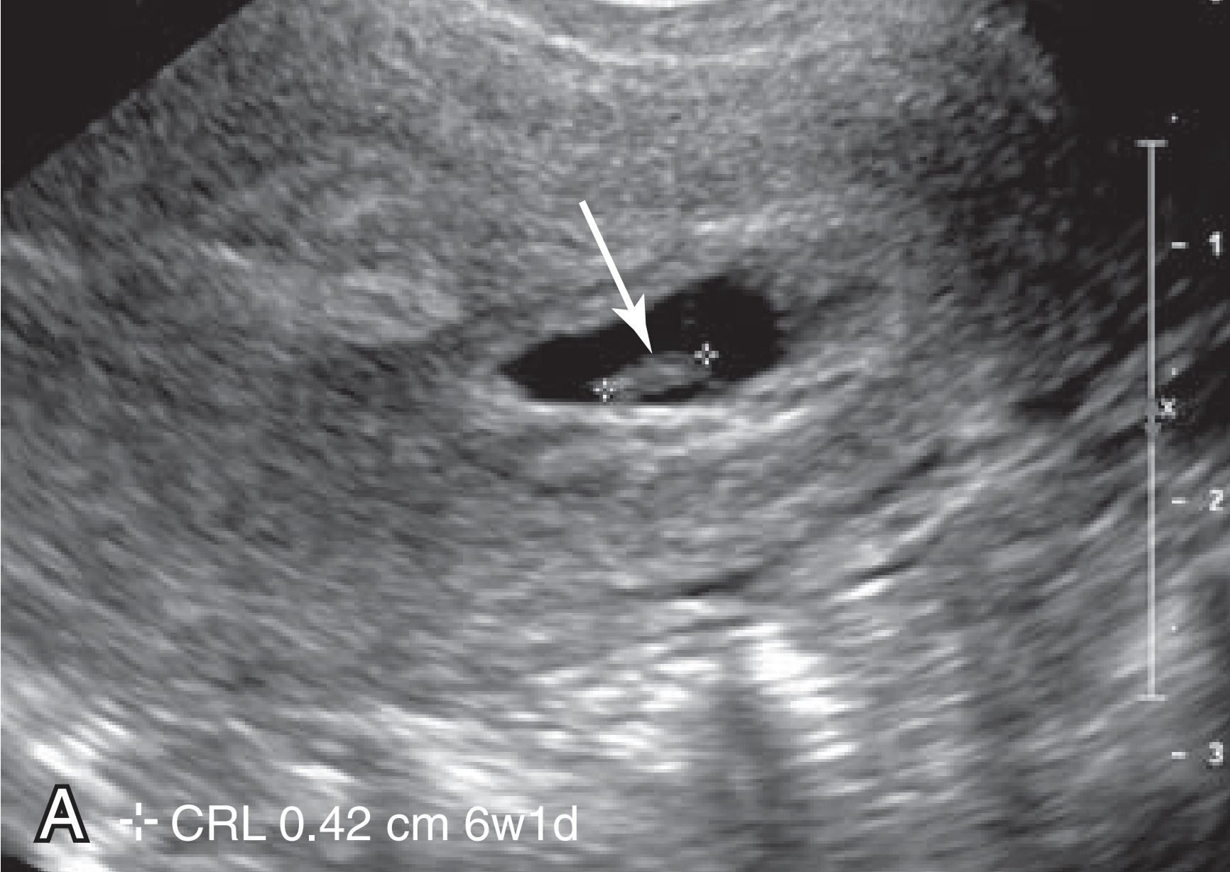 Tiêu chuẩn chẩn đoán thai ngừng phát triển (Sẩy thai quý I)