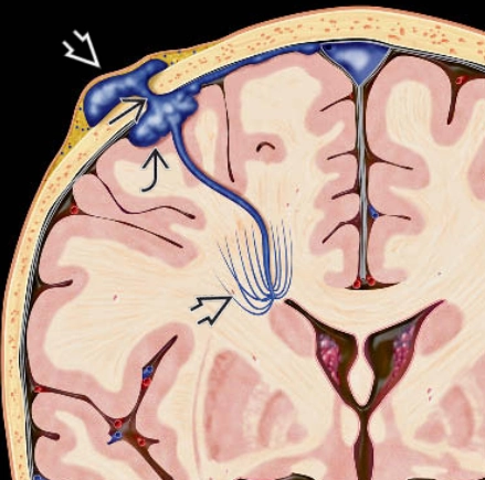 Xoang màng cứng da đầu (Sinus Pericranii)