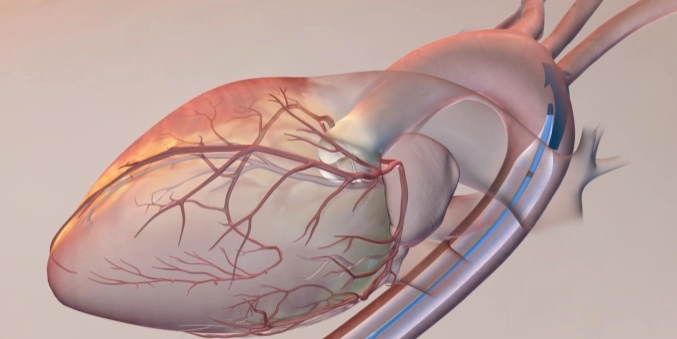 Bóng đối xung trong động mạch chủ (Intra-aortic balloon pump - IABP)