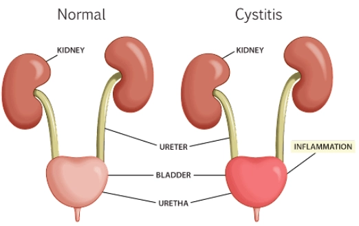 Viêm bàng quang (Cystitis)