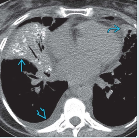 Bệnh phổi thoái hóa dạng bột (Amyloidosis pulmonary)