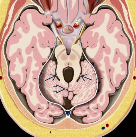 CÁC RỐI LOẠN LIÊN QUAN ĐẾN HỘI CHỨNG JOUBERT (JOUBERT SYNDROME RELATED DISORDERS - JSRD)
