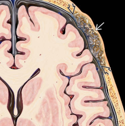 Di căn xương sọ (Skull Metastases)