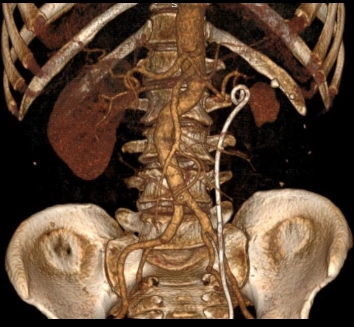 Giả phình động mạch thận (Renal Artery Pseudoaneurysm)