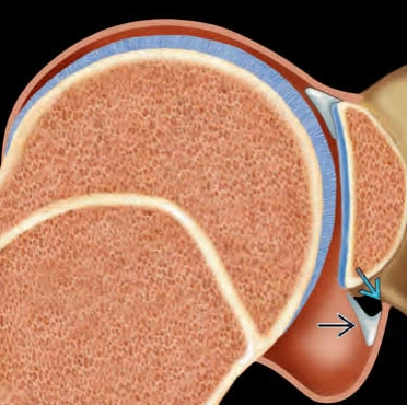 Tổn thương ALPSA (Anterior Labrum Periosteal Sleeve Avulsion)