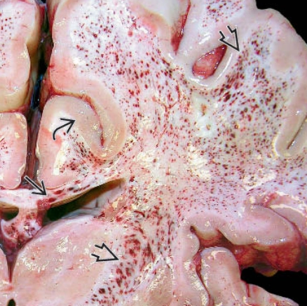 Viêm não chất trắng xuất huyết cấp tính (Acute Hemorrhagic Leukoencephalitis- AHLE)