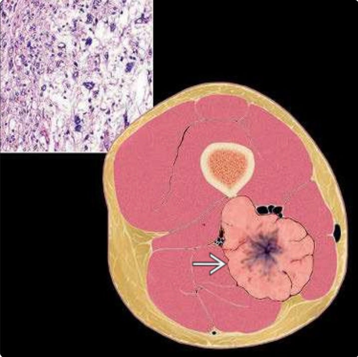 U mô mềm (Soft tissue tumors)