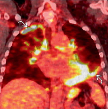 Kỹ thuật làm dính màng phổi (Pleurodesis)
