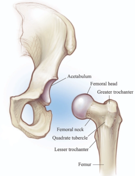 Thay khớp háng bán phần (Hip hemiarthroplasty)