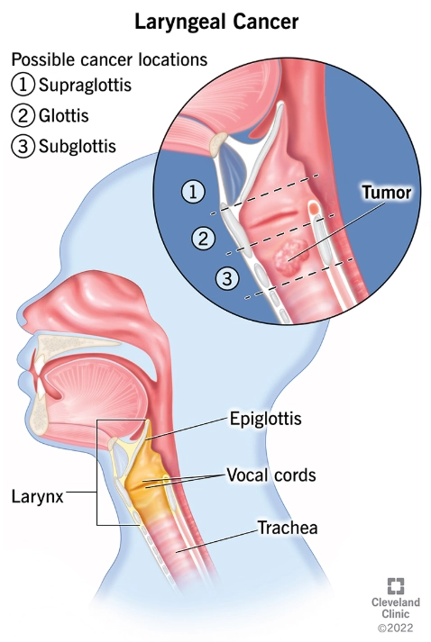 Phân giai đoạn Ung thư biểu mô Thanh quản (Laryngeal carcinoma (staging))