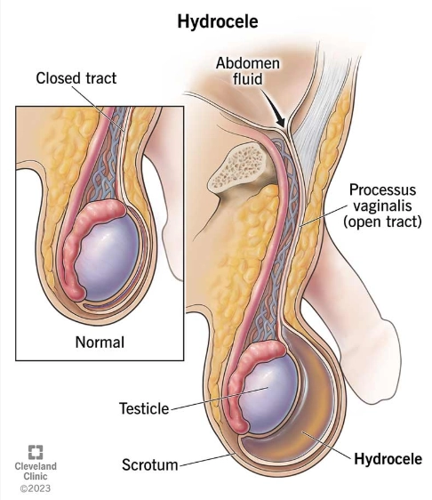Tràn dịch tinh mạc (Hydrocele)