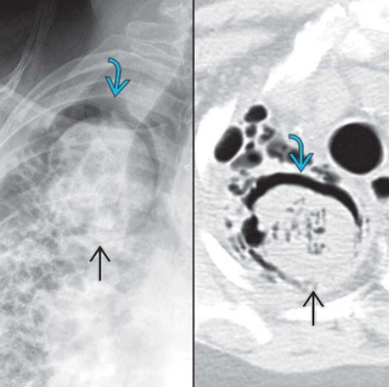 Dấu hiệu liềm khí (Air Crescent Sign)