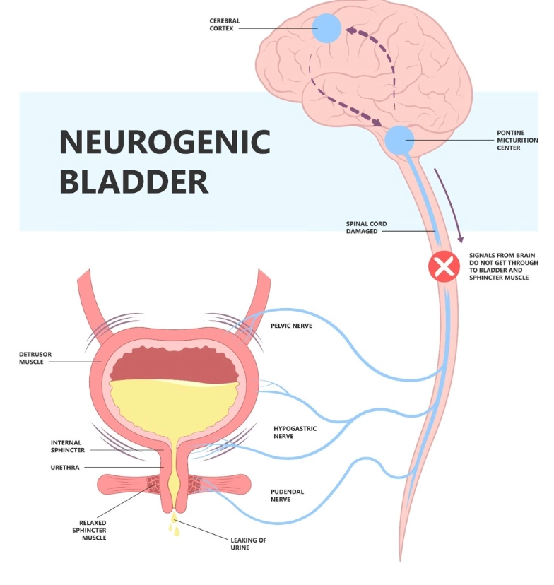 Bàng quang thần kinh (Neurogenic bladder)
