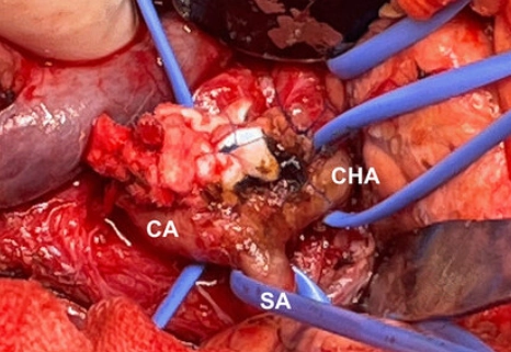 Phình động mạch thân tạng (Celiac Artery Aneurysm - CAA)