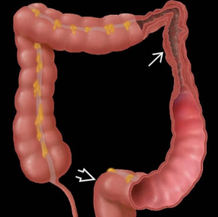 Viêm đại tràng thiếu máu cục bộ (Ischemic colitis)